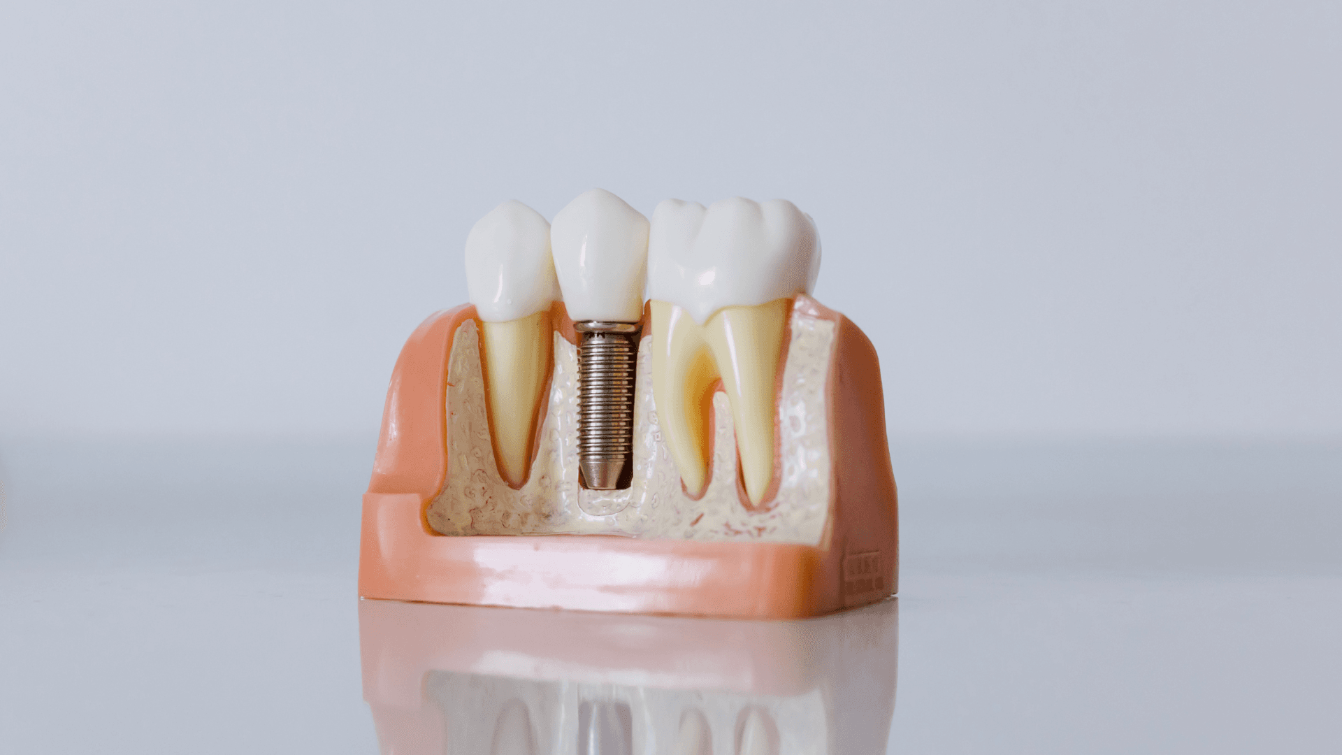 Things to Consider When Getting Dental Implants