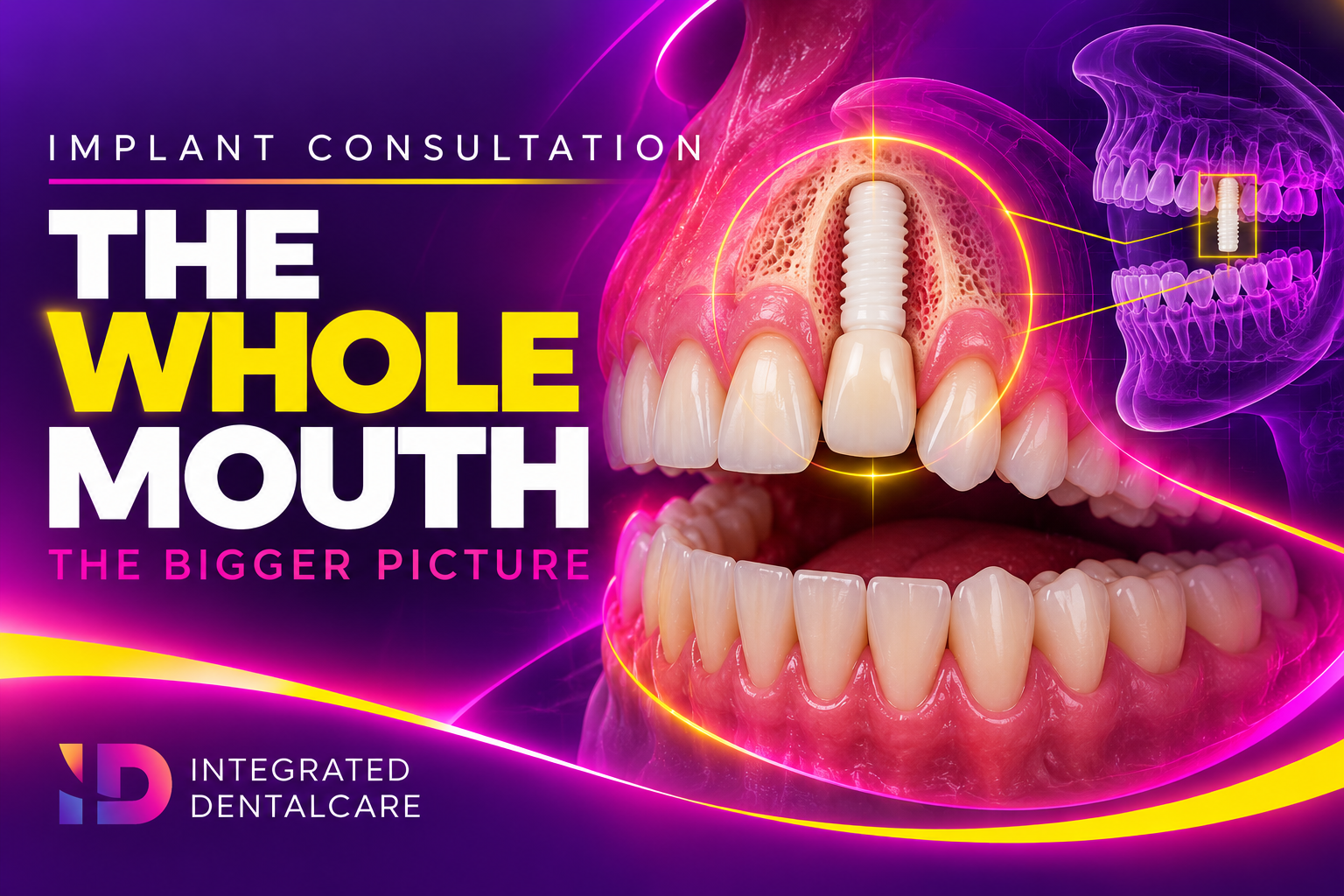 Implant Consultation & Whole-Mouth Overview