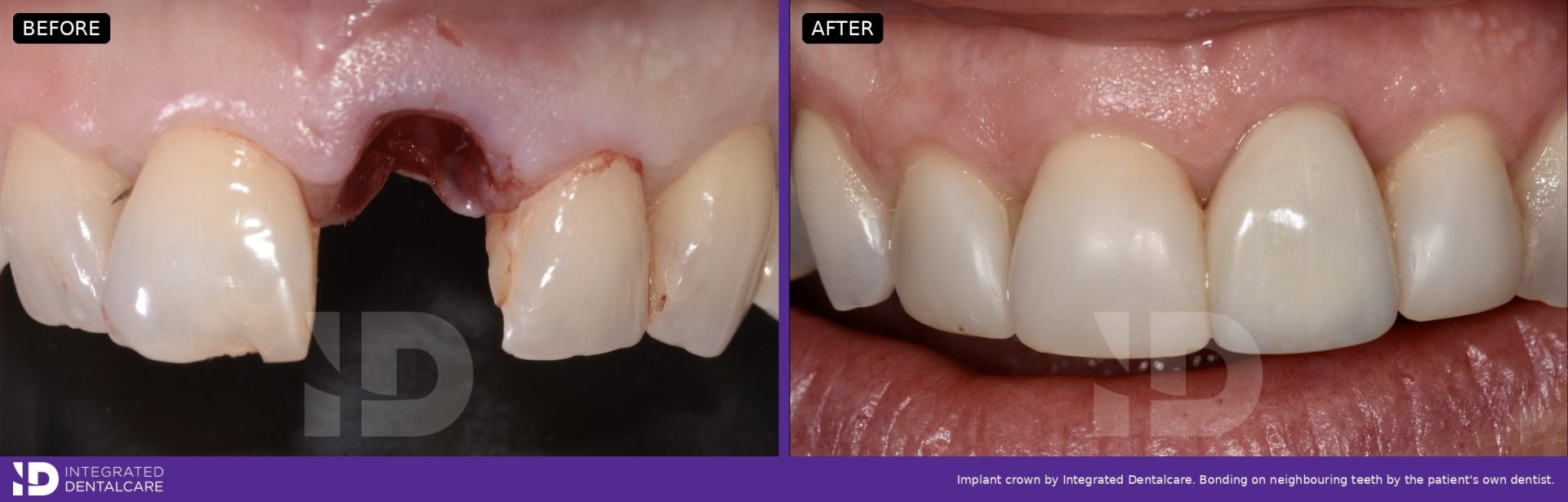 Before and after: upper front tooth removed and replaced the same day with a Straumann ceramic implant, shown with the final crown four months later, Integrated Dentalcare, Edinburgh