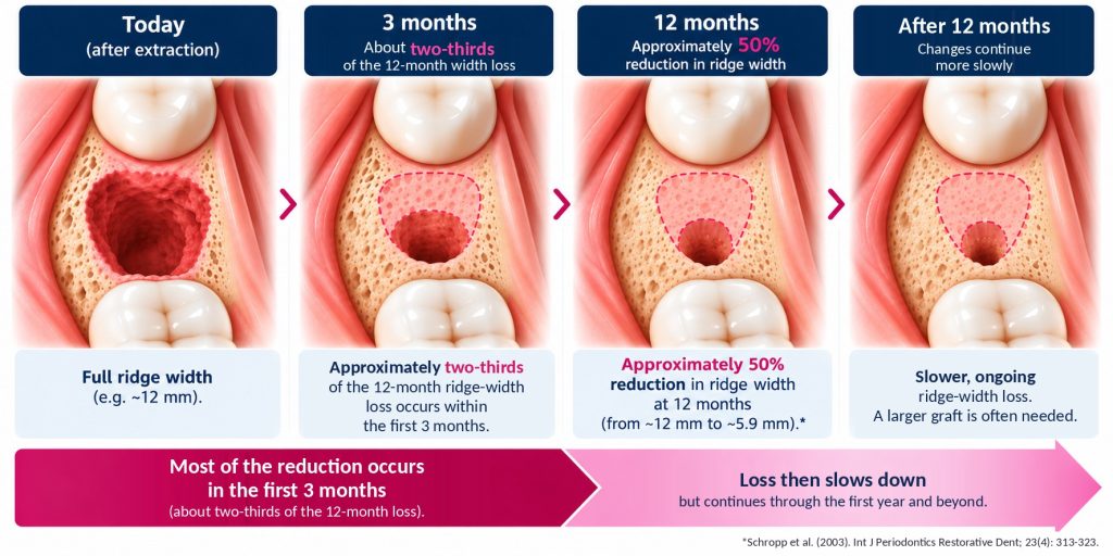 Illustration of a tooth socket healing after extraction: about two-thirds of the first year's ridge-width loss happens in the first 3 months, reaching about 50% at 12 months, then slower ongoing loss (Schropp et al. 2003)